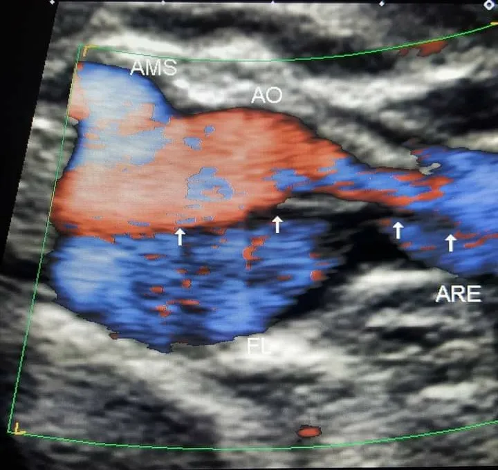 Doppler colorido mostrando o flap intimal da dissecção aórtica