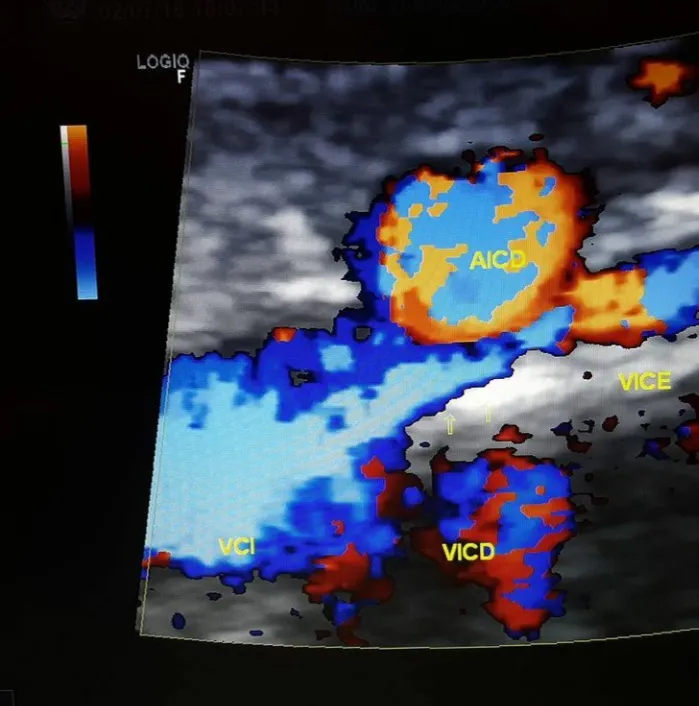 Imagem de Doppler vascular avaliando a veia ilíaca esquerda