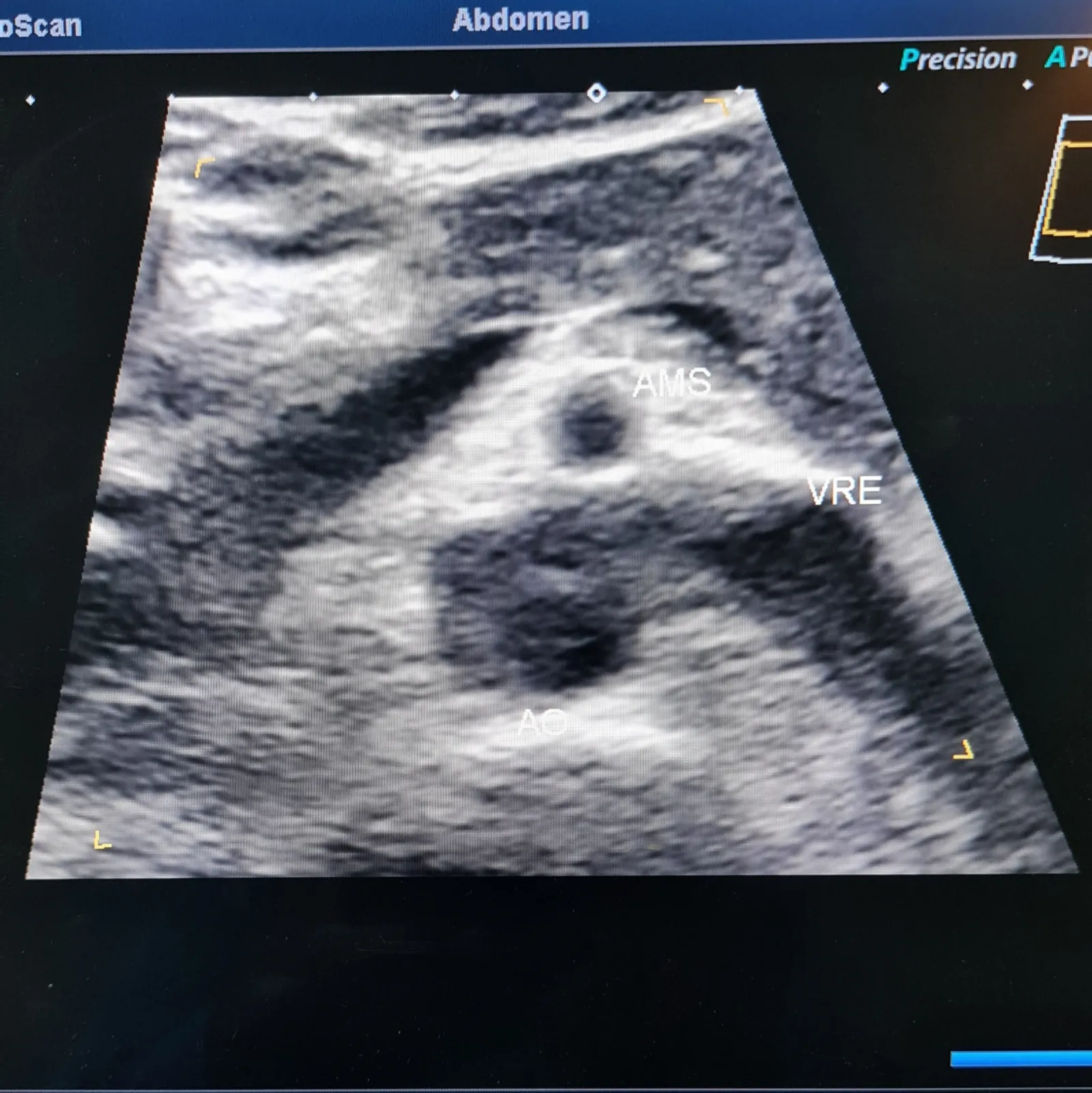 Ultrassom modo B do trajeto da veia renal esquerda entre aorta e artéria mesentérica superior