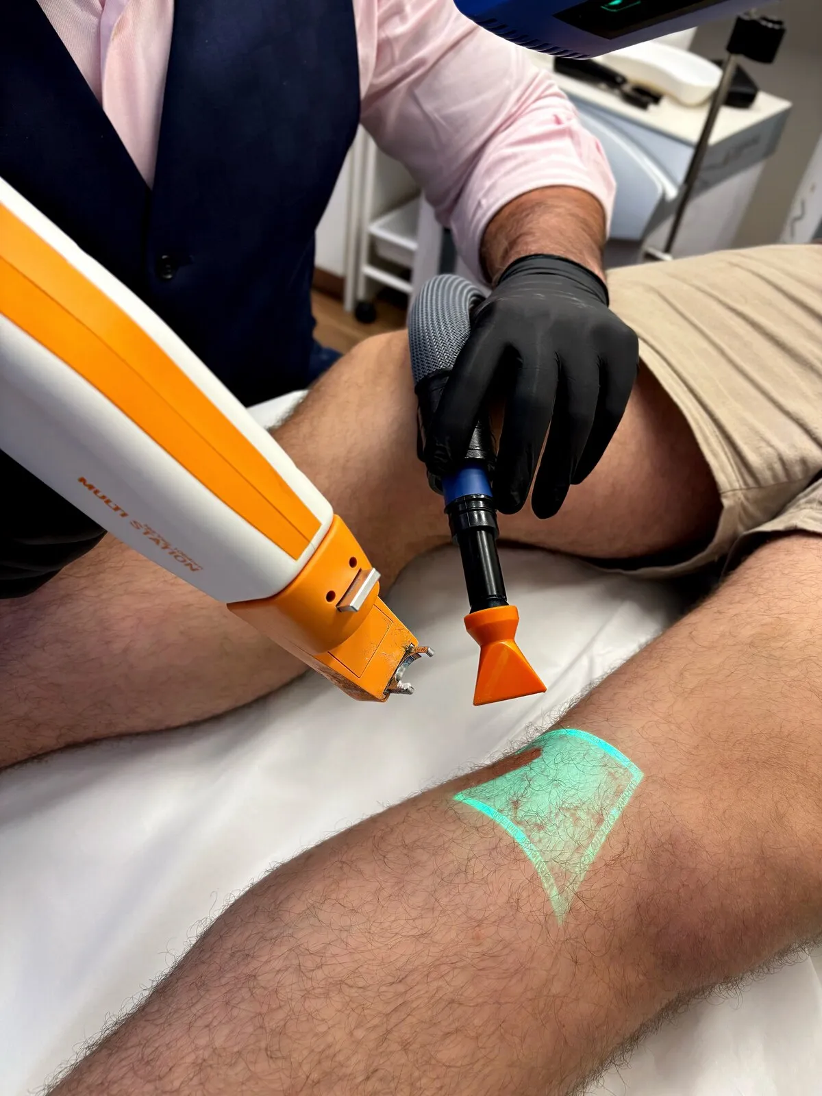 Sessão de laser transdérmico para vasinhos na Clínica AngioScan