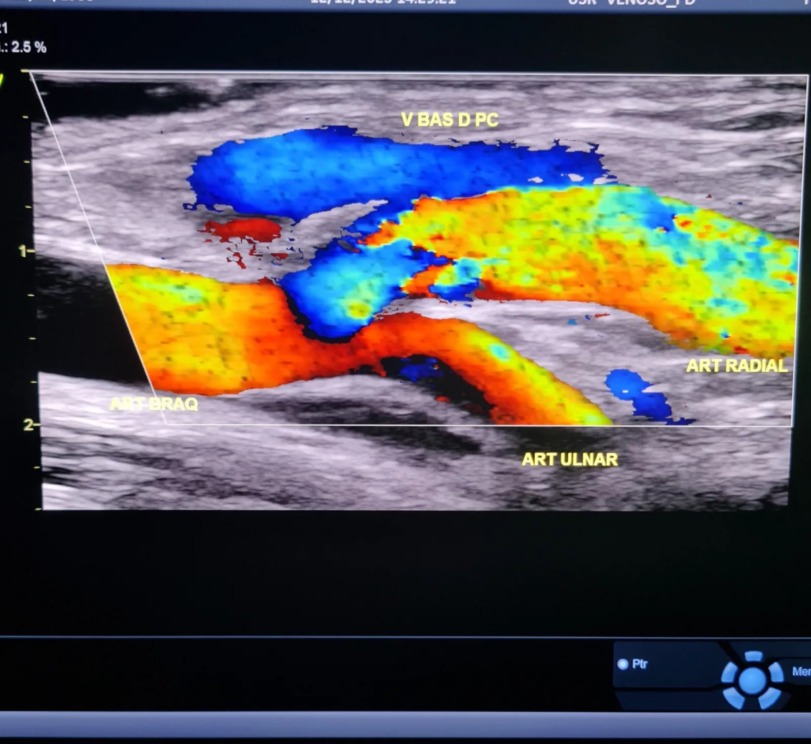 Doppler colorido mostrando a bifurcação da artéria braquial em radial e ulnar