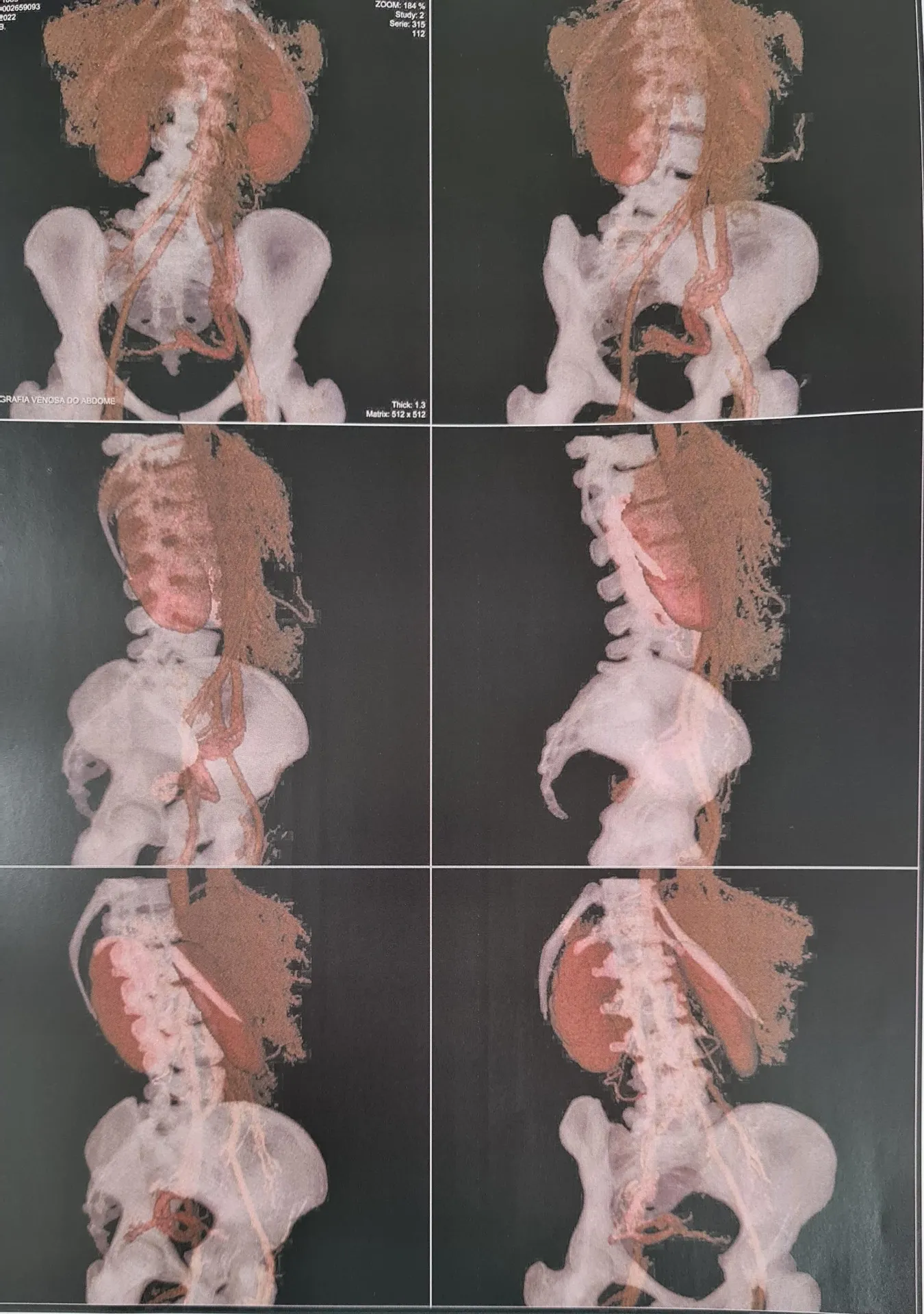 Reconstruções 3D de angiotomografia venosa do abdome e pelve em múltiplas projeções