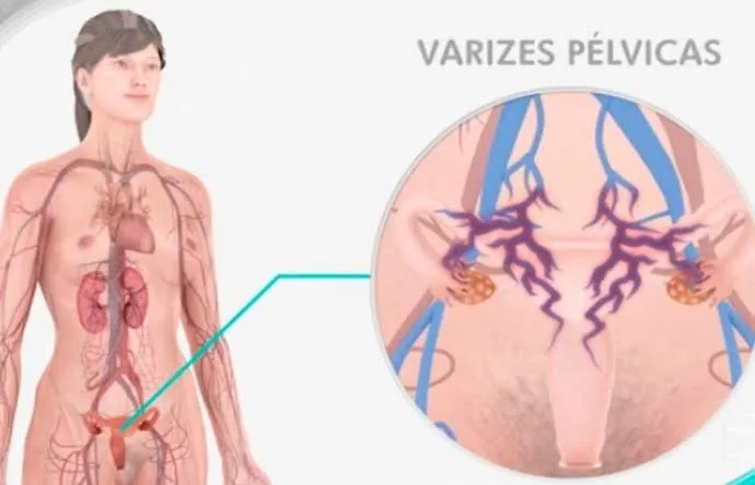 Ilustração das varizes pélvicas: veias dilatadas ao redor do útero e dos ovários