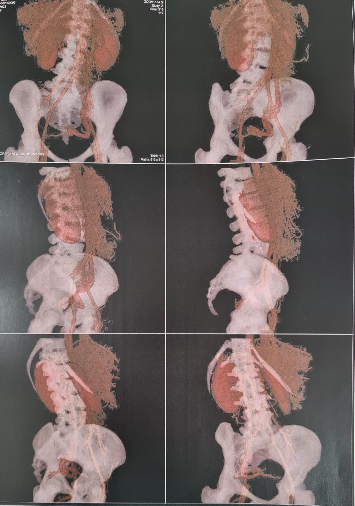 Reconstruções 3D de angiotomografia venosa do abdome e pelve em múltiplas projeções