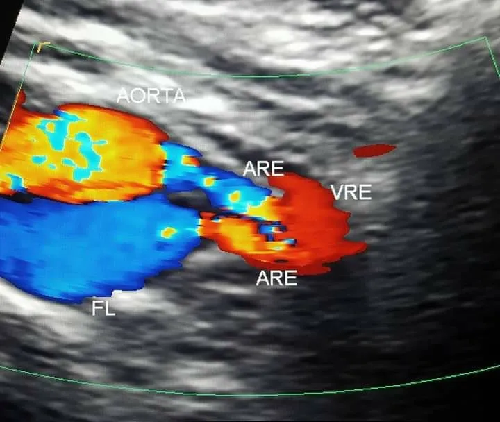 Doppler colorido evidenciando luz verdadeira e falsa luz em dissecção aórtica