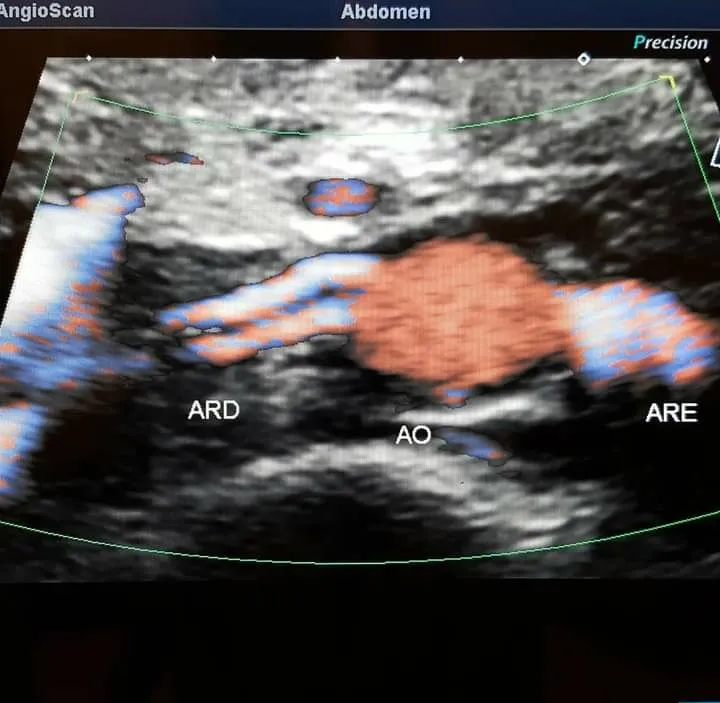Doppler colorido da aorta abdominal com artérias renais direita e esquerda