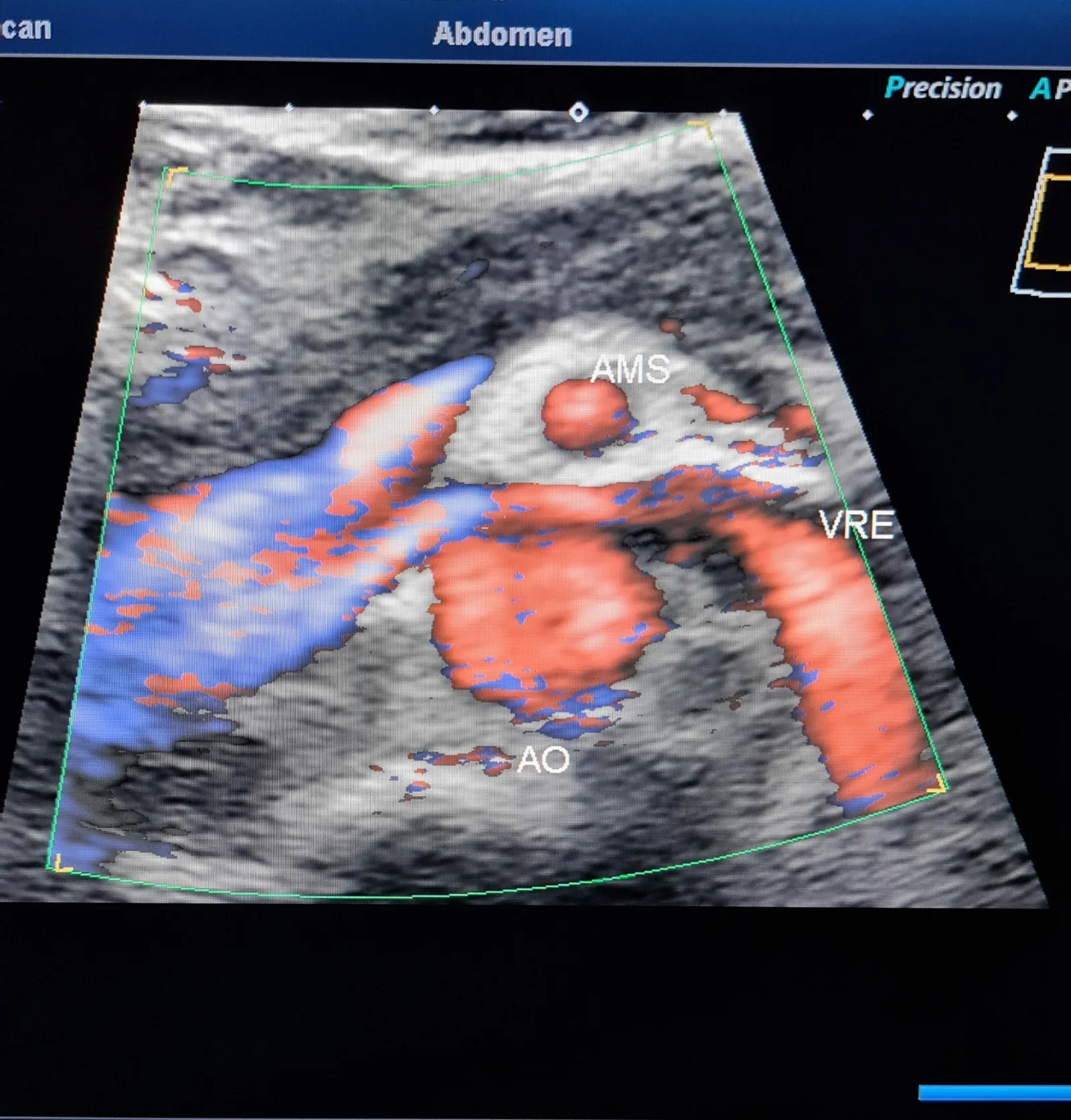 Doppler colorido da veia renal esquerda comprimida entre aorta e artéria mesentérica superior