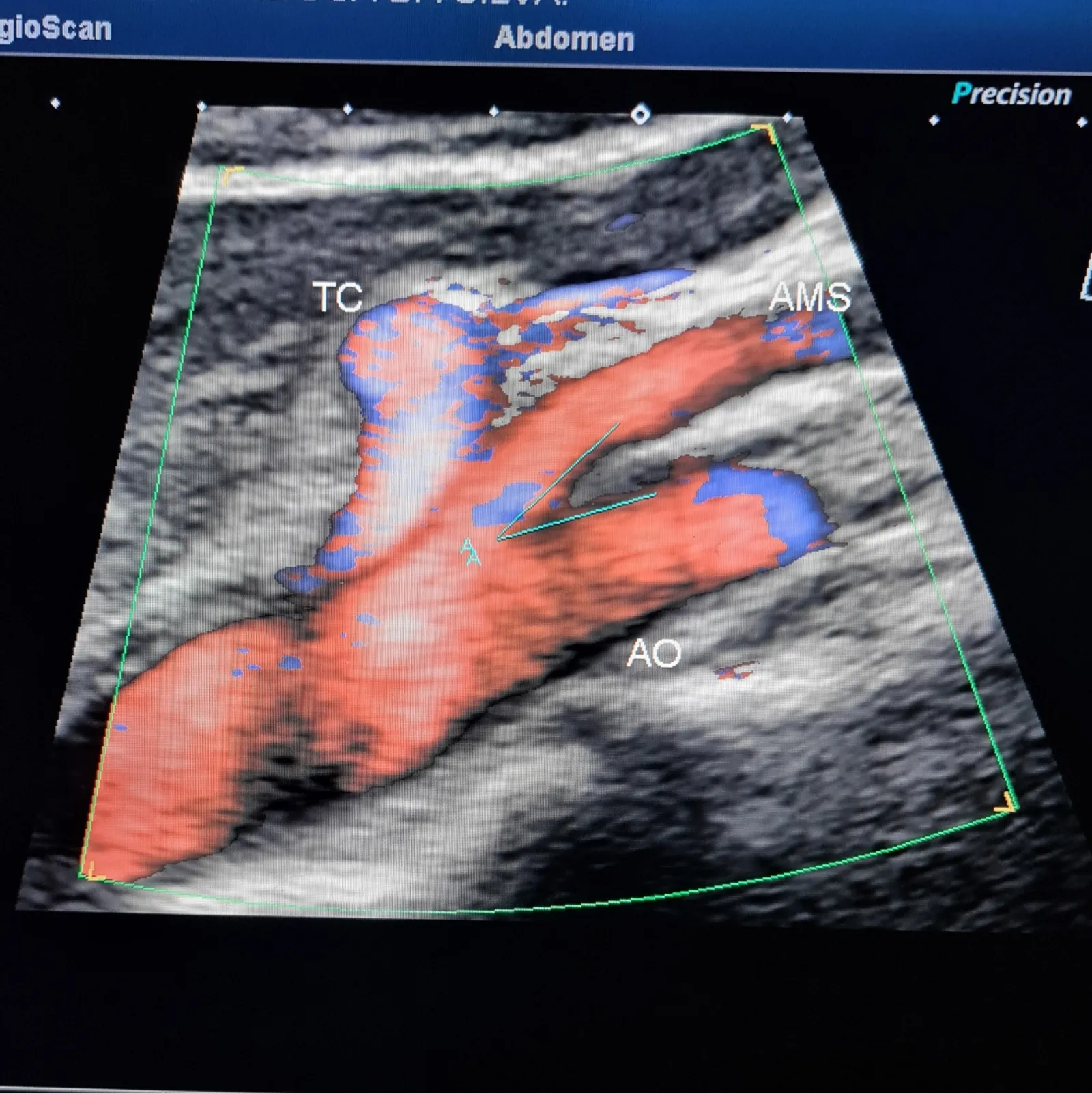 Doppler abdominal com medida do ângulo aorto-mesentérico